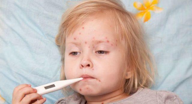 les symptômes de la rougeole