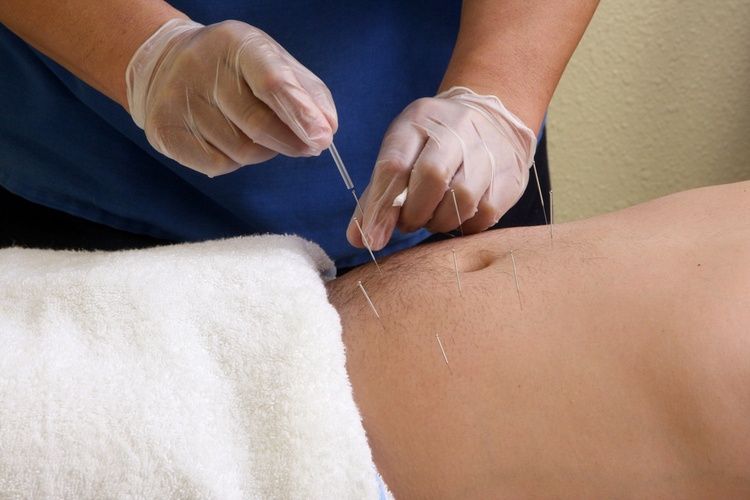 acupuncture-minceur