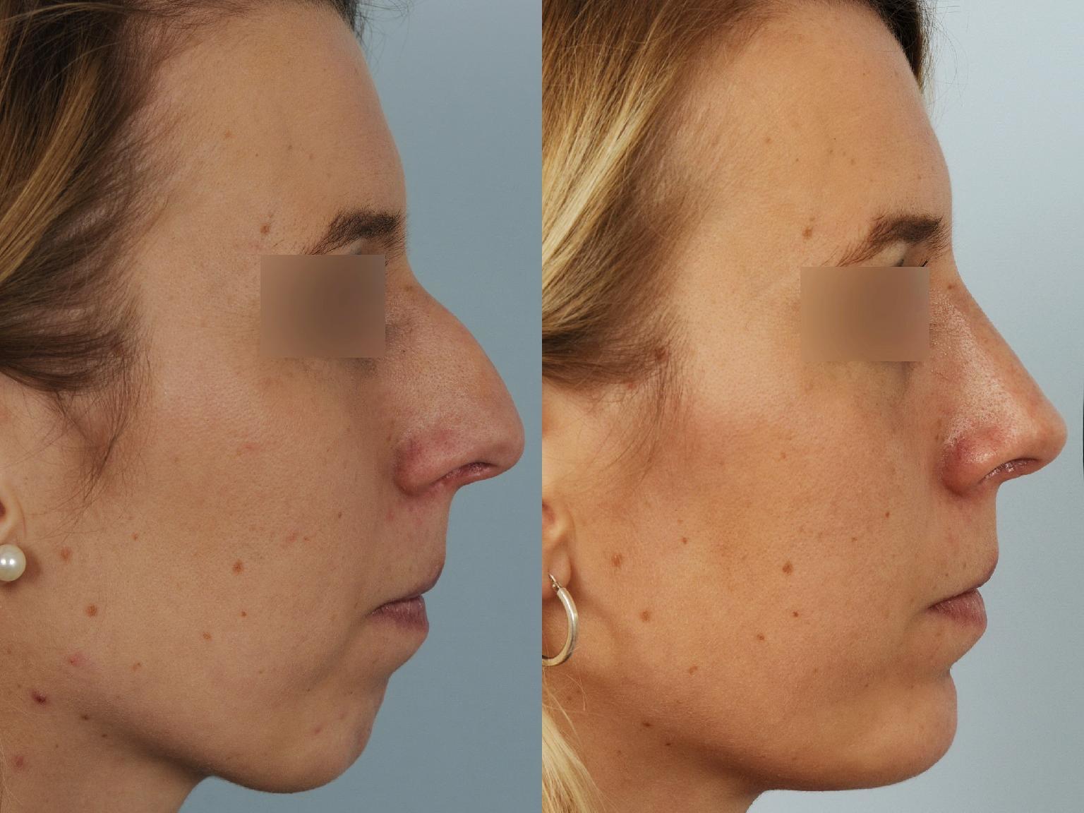 Profiloplastie : Avancée du menton