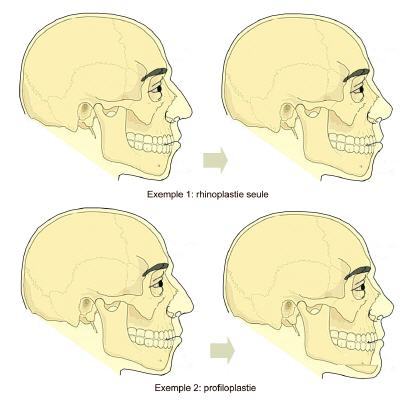Mesurer les reliefs du visage avec la Profiloplastie