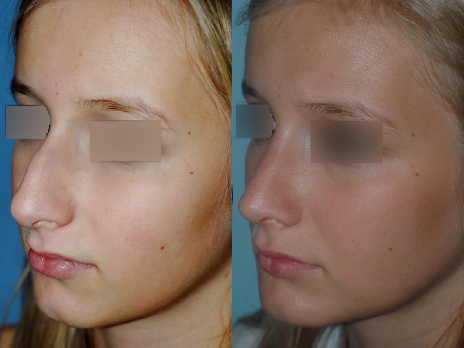 Profiloplastie : Avancée du menton