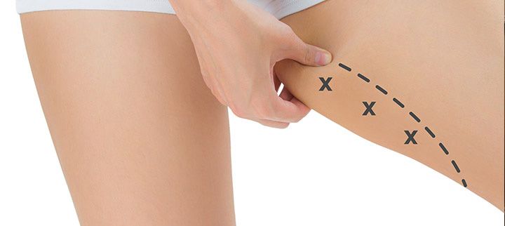lifting cuisse